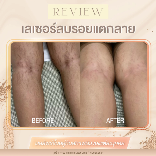 ผลลัพธ์หลังเลเซอร์ลดรอยแตกลาย โปรแกรม Pico Enlighten ที่ Timeless Laser Clinic รูป13