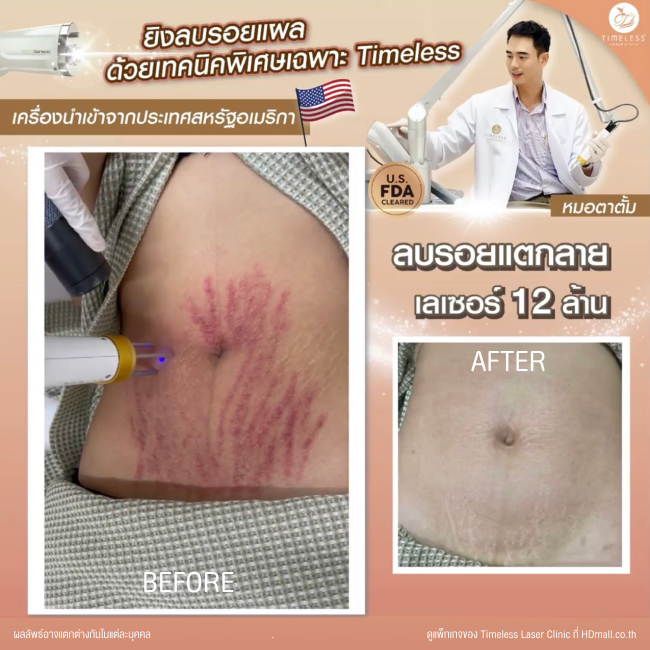 ผลลัพธ์หลังเลเซอร์ลดรอยแตกลาย โปรแกรม Pico Enlighten ที่ Timeless Laser Clinic รูป1