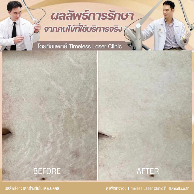 ผลลัพธ์หลังเลเซอร์ลดรอยแตกลาย โปรแกรม Pico Enlighten ที่ Timeless Laser Clinic รูป2