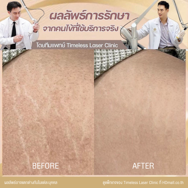 ผลลัพธ์หลังเลเซอร์ลดรอยแตกลาย โปรแกรม Pico Enlighten ที่ Timeless Laser Clinic รูป3