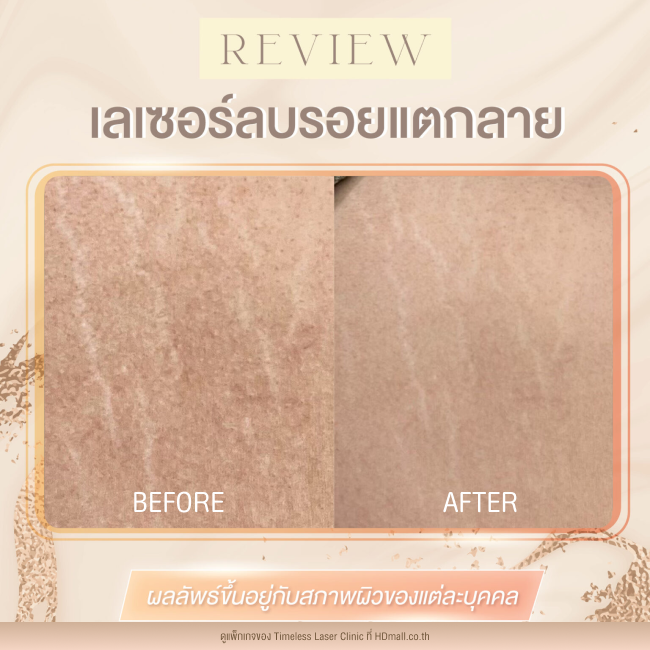 ผลลัพธ์หลังเลเซอร์ลดรอยแตกลาย โปรแกรม Pico Enlighten ที่ Timeless Laser Clinic รูป4