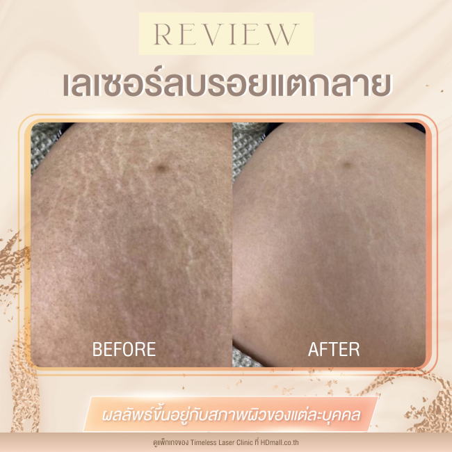 ผลลัพธ์หลังเลเซอร์ลดรอยแตกลาย โปรแกรม Pico Enlighten ที่ Timeless Laser Clinic รูป5