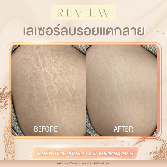 ผลลัพธ์หลังเลเซอร์ลดรอยแตกลาย โปรแกรม Pico Enlighten ที่ Timeless Laser Clinic รูป6