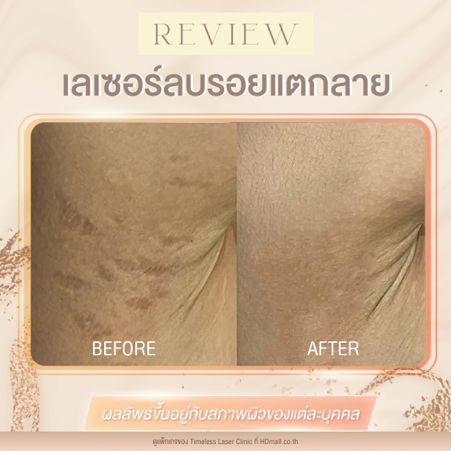 ผลลัพธ์หลังเลเซอร์ลดรอยแตกลาย โปรแกรม Pico Enlighten ที่ Timeless Laser Clinic รูป7