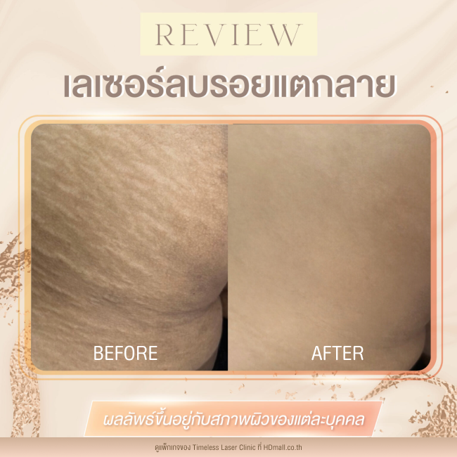 ผลลัพธ์หลังเลเซอร์ลดรอยแตกลาย โปรแกรม Pico Enlighten ที่ Timeless Laser Clinic รูป8