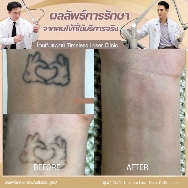 ผลลัพธ์หลังลบรอยสัก ลบรอยสักคิ้ว โปรแกรม Pico Enlighten ที่ Timeless Laser Clinic รูป 9