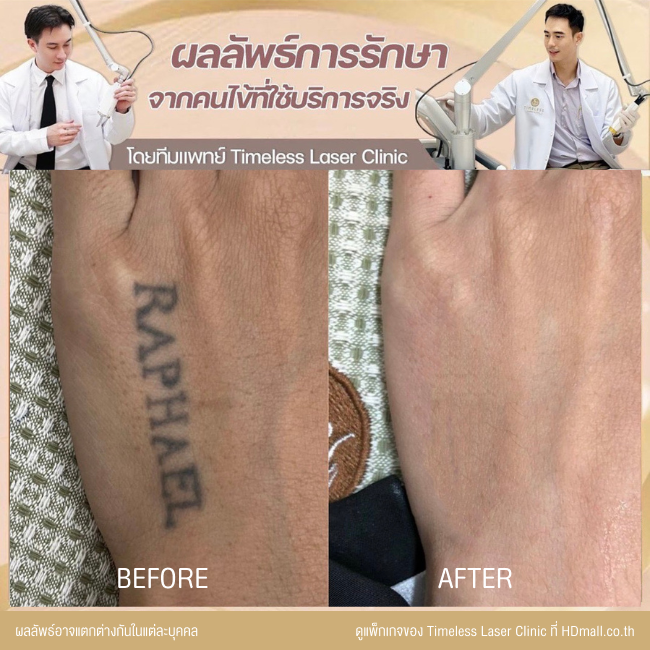 ผลลัพธ์หลังลบรอยสัก ลบรอยสักคิ้ว โปรแกรม Pico Enlighten ที่ Timeless Laser Clinic รูป 11