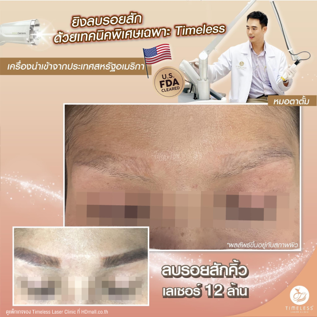 ผลลัพธ์หลังลบรอยสัก ลบรอยสักคิ้ว โปรแกรม Pico Enlighten ที่ Timeless Laser Clinic รูป 1