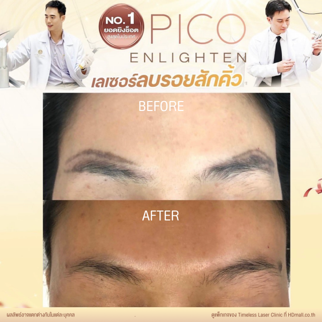 ผลลัพธ์หลังลบรอยสัก ลบรอยสักคิ้ว โปรแกรม Pico Enlighten ที่ Timeless Laser Clinic รูป 2