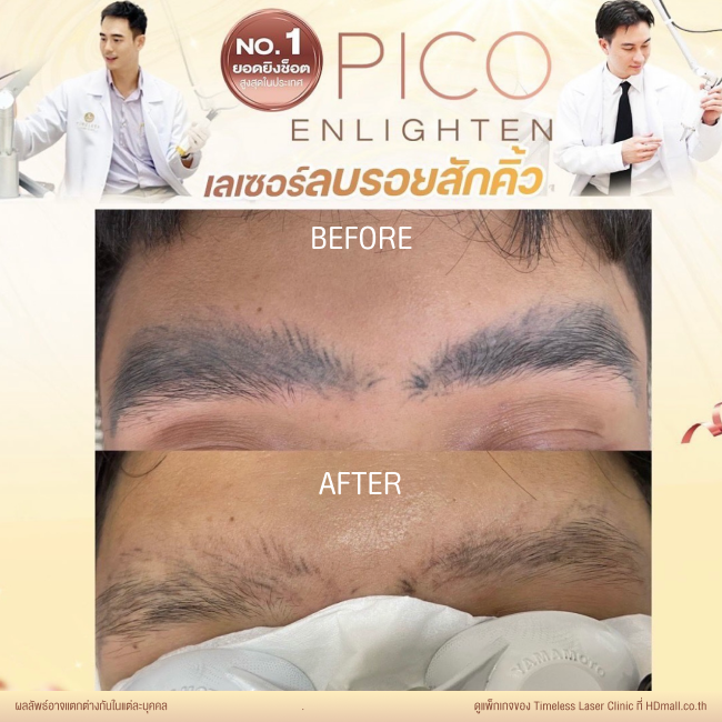 ผลลัพธ์หลังลบรอยสัก ลบรอยสักคิ้ว โปรแกรม Pico Enlighten ที่ Timeless Laser Clinic รูป 3