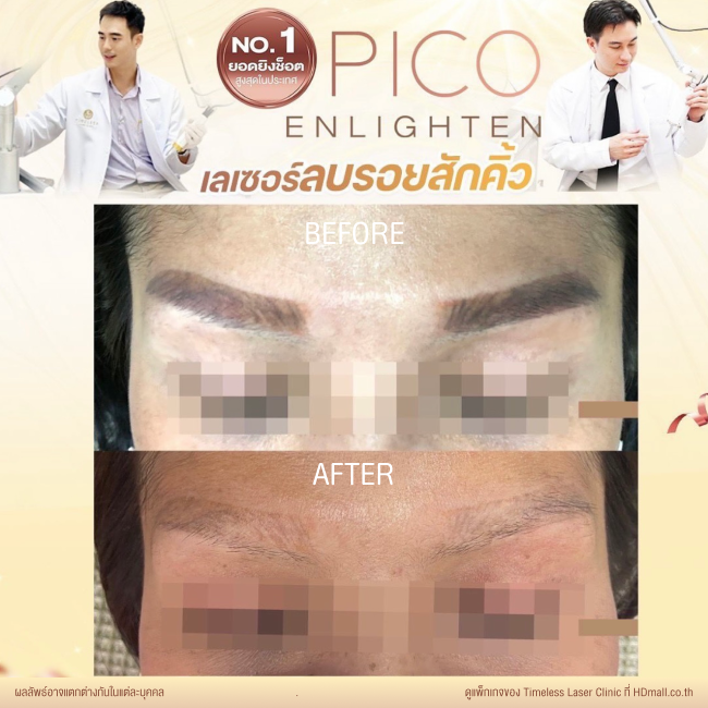 ผลลัพธ์หลังลบรอยสัก ลบรอยสักคิ้ว โปรแกรม Pico Enlighten ที่ Timeless Laser Clinic รูป 4