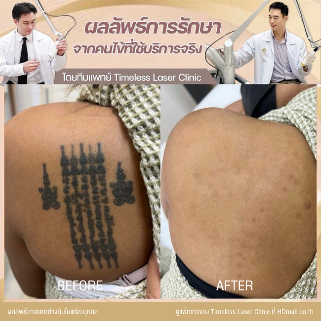 ผลลัพธ์หลังลบรอยสัก ลบรอยสักคิ้ว โปรแกรม Pico Enlighten ที่ Timeless Laser Clinic รูป 5