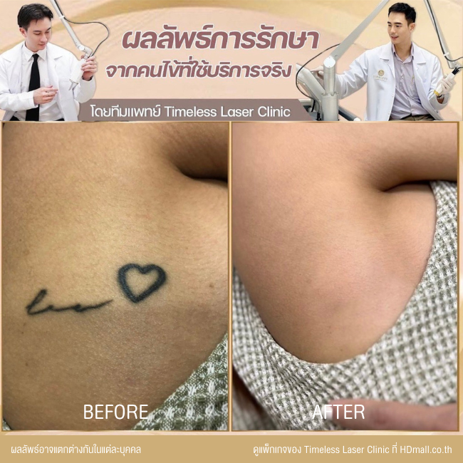 ผลลัพธ์หลังลบรอยสัก ลบรอยสักคิ้ว โปรแกรม Pico Enlighten ที่ Timeless Laser Clinic รูป 6