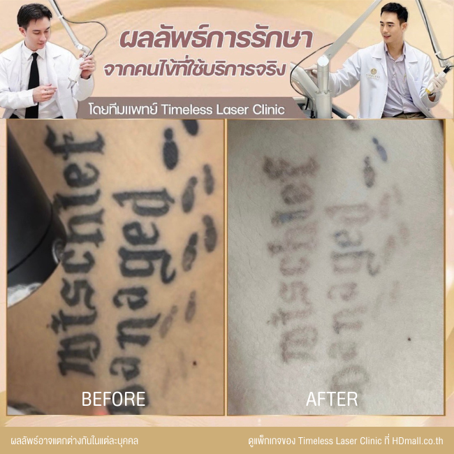 ผลลัพธ์หลังลบรอยสัก ลบรอยสักคิ้ว โปรแกรม Pico Enlighten ที่ Timeless Laser Clinic รูป 8