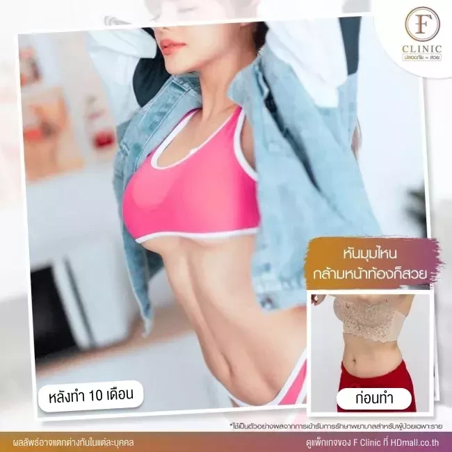 รีวิวดูดไขมัน Sexy Line ที่ F Clinic
