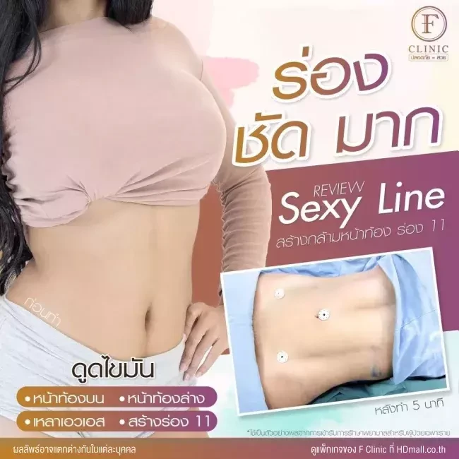 รีวิว ดูดไขมันบริเวณหน้าท้อง ทำ Sexy Line ที่ F Clinic