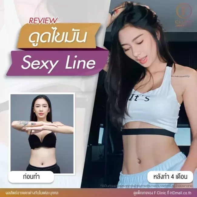 รีวิวดูดไขมัน Sexy Line ที่ F Clinic