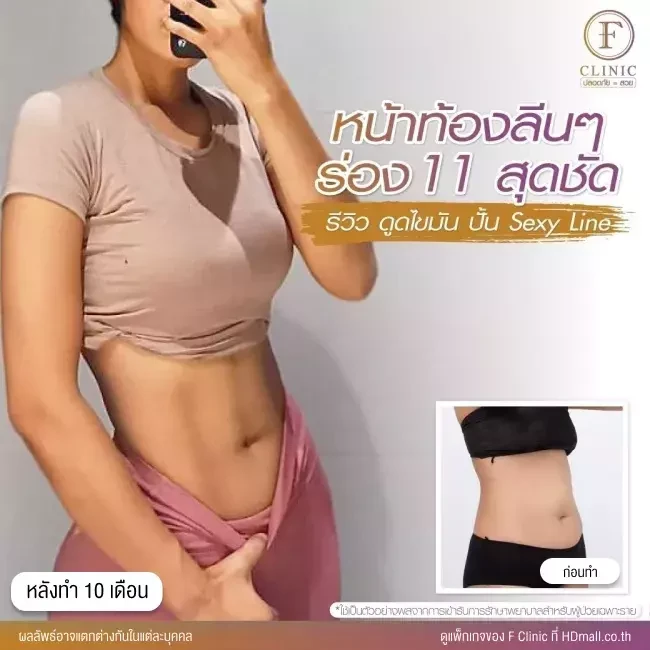 รีวิว ดูดไขมันบริเวณหน้าท้อง ทำ Sexy Line ที่ F Clinic