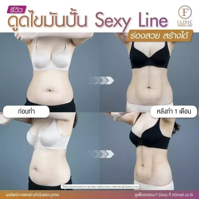 รีวิวดูดไขมัน Sexy Line ที่ F Clinic