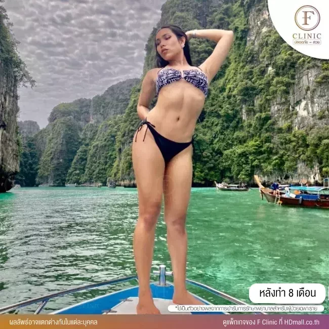 รีวิว ดูดไขมันบริเวณหน้าท้อง ทำ Sexy Line ที่ F Clinic