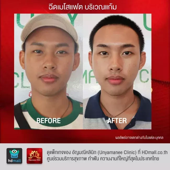 รีวิว ฉีดเมโสแฟต สลายไขมัน ที่ อัญมณีคลินิก Unyamanee clinic