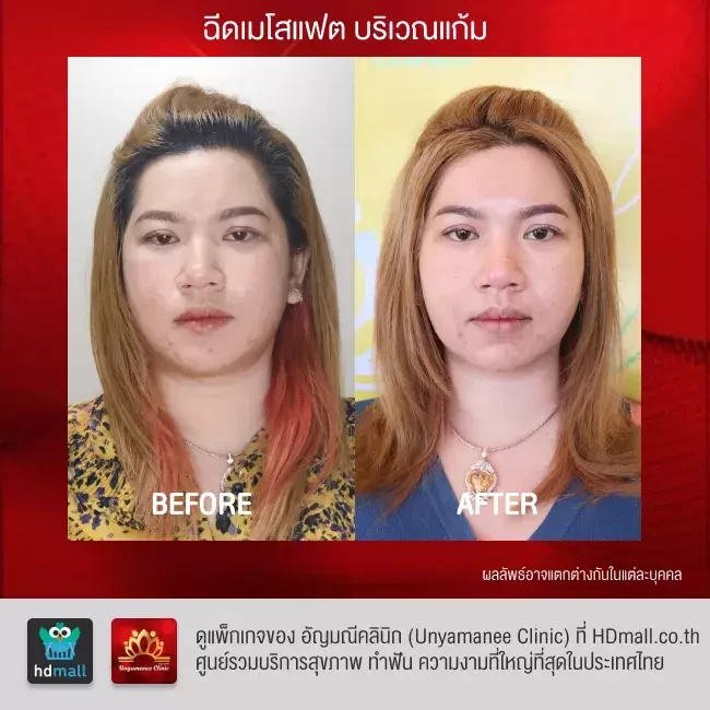 รีวิว ฉีดเมโสแฟต สลายไขมัน ที่ อัญมณีคลินิก Unyamanee clinic