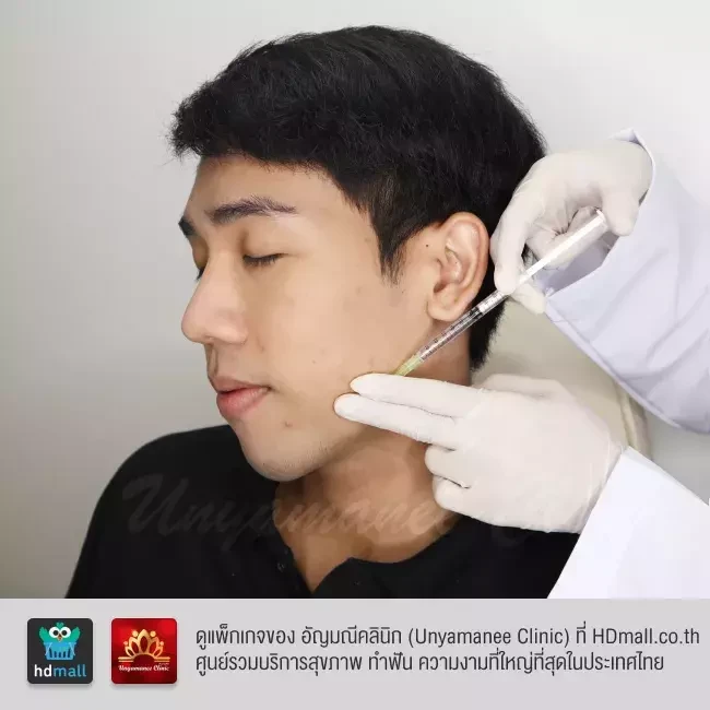 รีวิว ฉีดเมโสแฟต สลายไขมัน ที่ อัญมณีคลินิก Unyamanee clinic