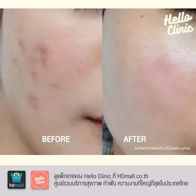 รีวิว ฉีดเมโสลดรอย จุดด่างดำ ฝ้ากระขนาดเล็ก ที่ Hello Clinic