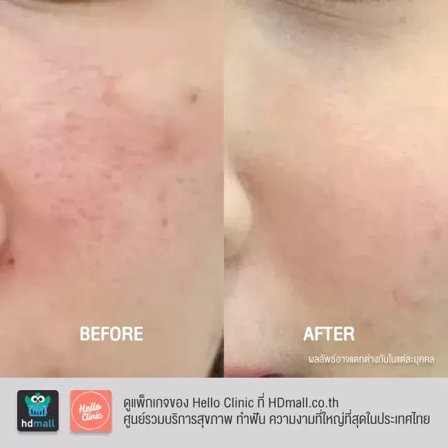 รีวิว ฉีดเมโสลดรอย จุดด่างดำ ฝ้ากระขนาดเล็ก ที่ Hello Clinic