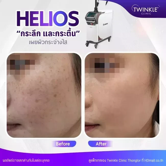 รีวิว เลเซอร์ Q-Switch ลดรอยฝ้า กระ จุดด่างดำ ที่ Twinkle Clinic Thonglor