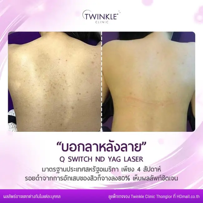 รีวิว เลเซอร์ Q-Switch ลดรอยฝ้า กระ จุดด่างดำ ที่ Twinkle Clinic Thonglor
