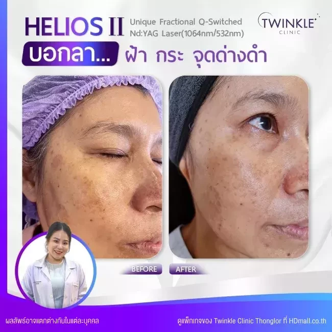 รีวิว เลเซอร์ Q-Switch ลดรอยฝ้า กระ จุดด่างดำ ที่ Twinkle Clinic Thonglor