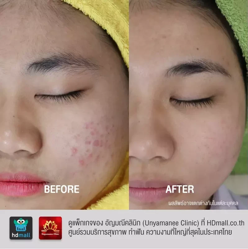 รีวิว รักษาสิว ที่ อัญมณีคลินิก Unyamanee clinic