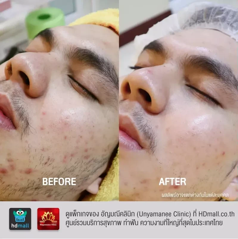 รีวิว รักษาสิว ที่ อัญมณีคลินิก Unyamanee clinic