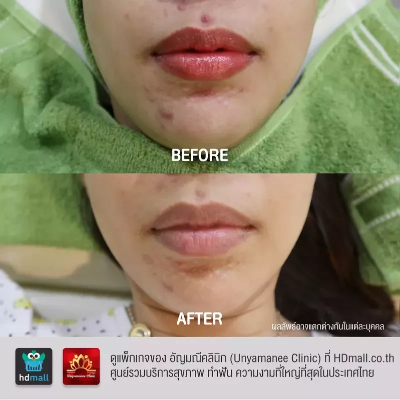 รีวิว รักษาสิว ที่ อัญมณีคลินิก Unyamanee clinic