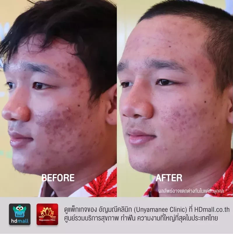 รีวิว รักษาสิว ที่ อัญมณีคลินิก Unyamanee clinic