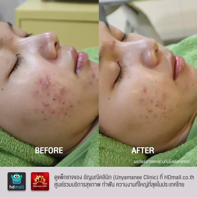 รีวิว รักษาสิว ที่ อัญมณีคลินิก Unyamanee clinic
