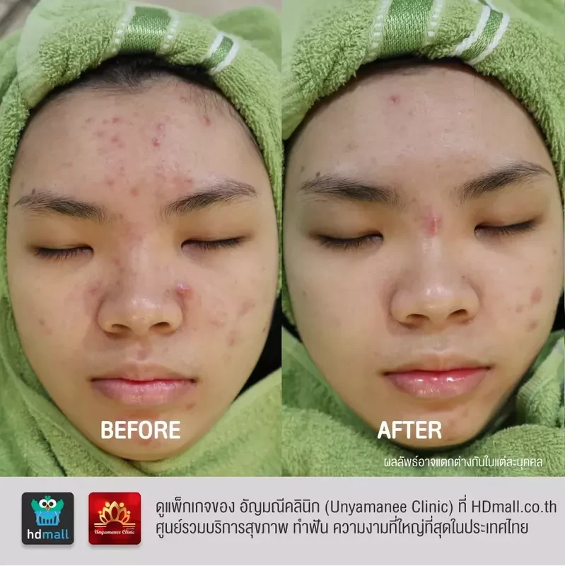 รีวิว รักษาสิว ที่ อัญมณีคลินิก Unyamanee clinic