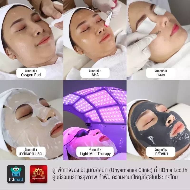 โปรแกรมรักษาสิวของ อัญมณีคลินิก Unyamanee clinic