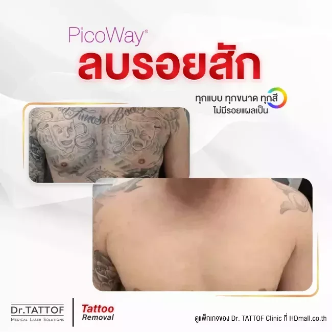 รีวิว ลบรอยสัก ด้วยเลเซอร์ PicoWay ที่ Dr. TATTOF Clinic