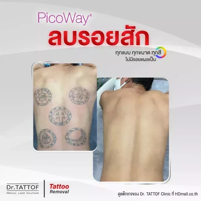 รีวิว ลบรอยสัก ด้วยเลเซอร์ PicoWay ที่ Dr. TATTOF Clinic
