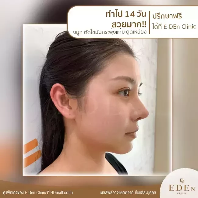 รีวิว เสริมจมูก ที่ E-Den Clinic