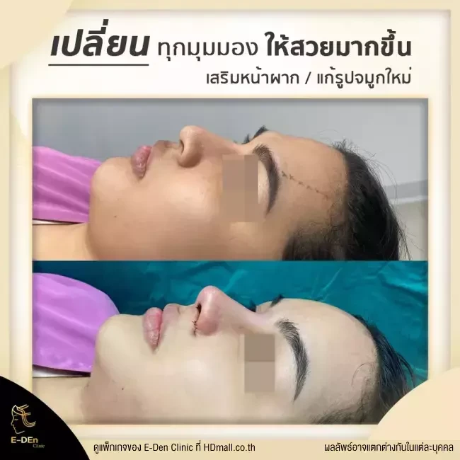 รีวิว เสริมจมูก ที่ E-Den Clinic