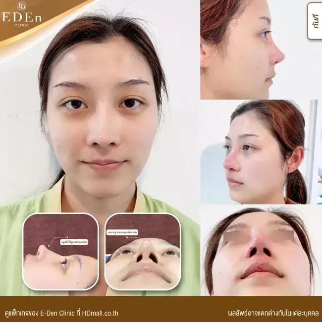 รีวิว เสริมจมูก ที่ E-Den Clinic
