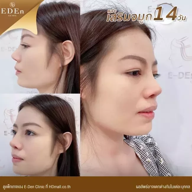รีวิว เสริมจมูก ที่ E-Den Clinic