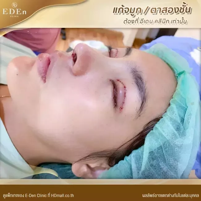 รีวิว เสริมจมูก ที่ E-Den Clinic