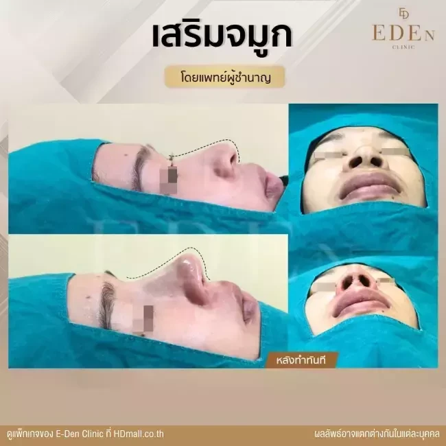 รีวิว เสริมจมูก ที่ E-Den Clinic