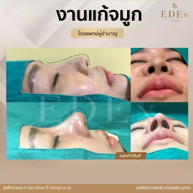 รีวิว เสริมจมูก ที่ E-Den Clinic