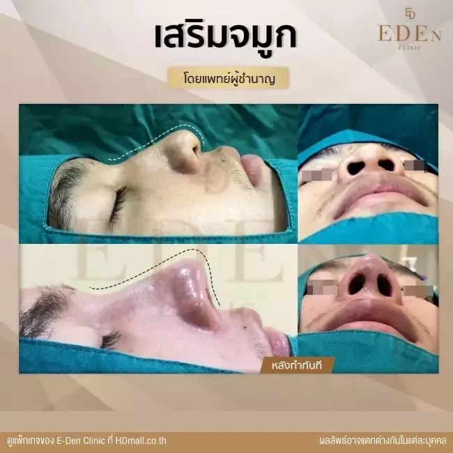 รีวิว เสริมจมูก ที่ E-Den Clinic