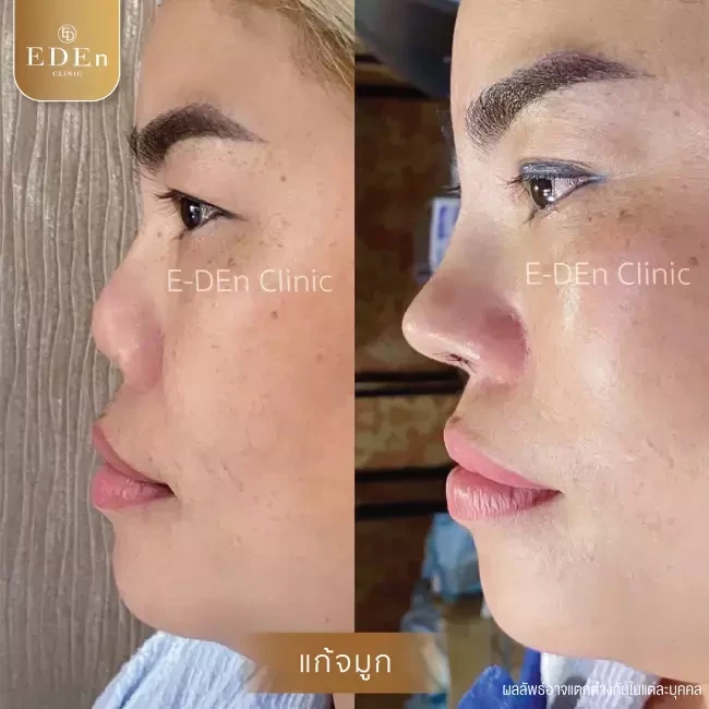 รีวิว เสริมจมูก ที่ E-Den Clinic